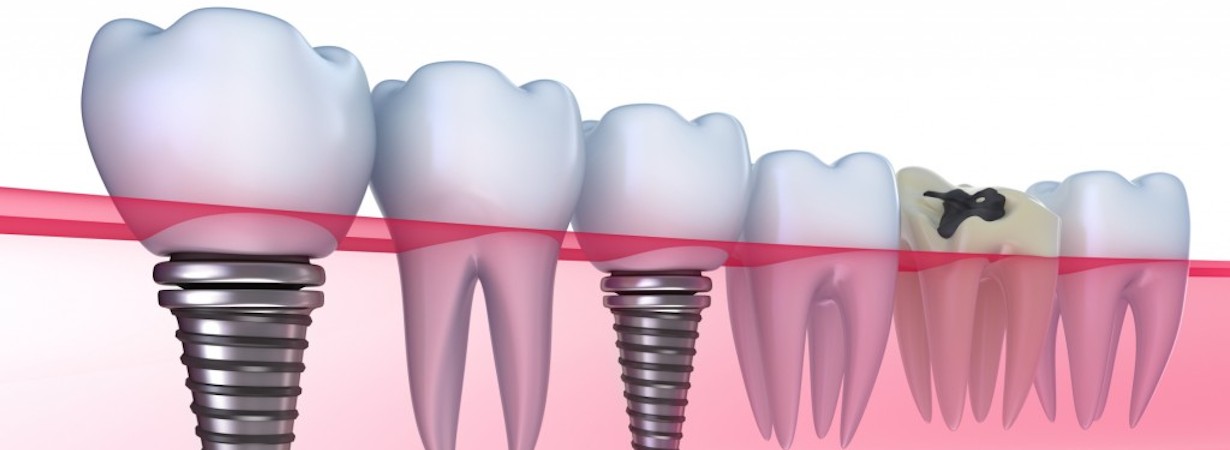 dental implant services in Salt Lake City UT