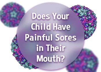 Salt Lake City dentist, Dr. Brickey at Natural Smiles Dentistry, tells parents about a common viral infection that may present with sores in their child’s mouth.