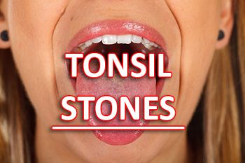 Salt Lake City dentist, Dr. Brickey at Natural Smiles Dentistry, tells patients about what causes tonsil stones and how to treat and prevent them from forming.