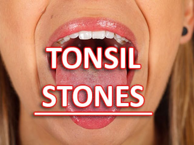 Suffering from a Sore Throat & Bad Breath? You Might Have Tonsil Stones (featured image)