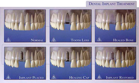 Dental Implant Treatment Illustration