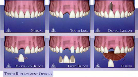 Implants Illustration